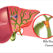 Rare Bile Duct cancer